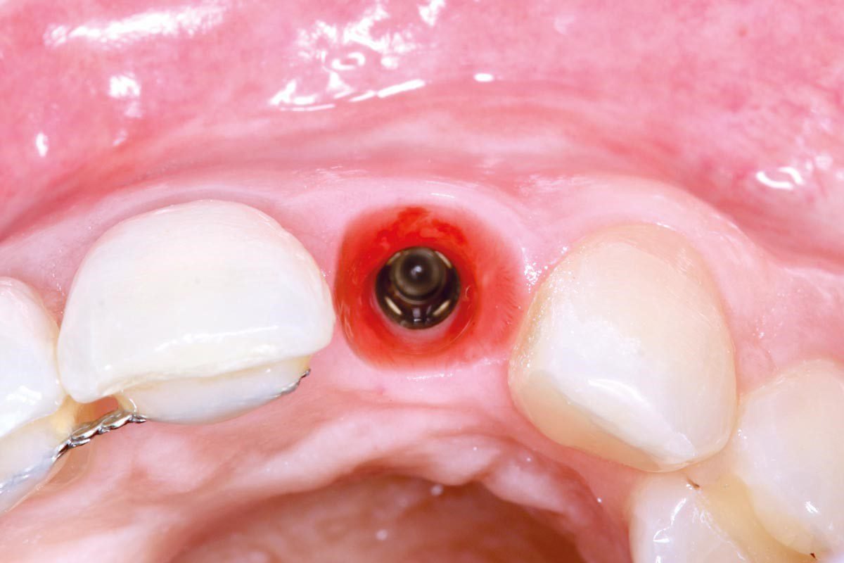 İmplant Tedavisi Nedir? Kimlere Uygundur? | Santral Klinik Bursa