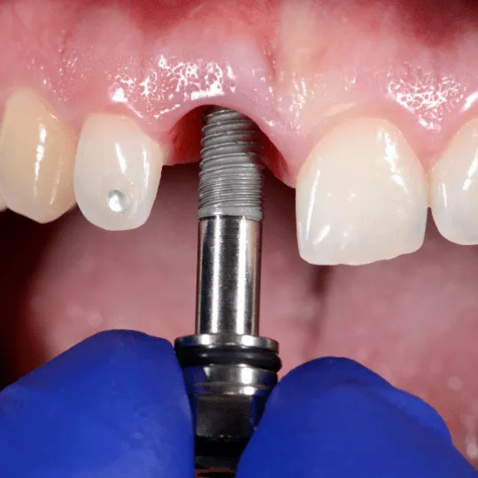 Bursa Nilüfer implant diş tedavisi - Santral Klinik